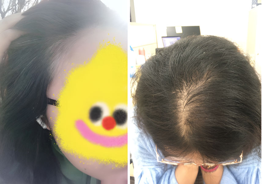90后恢复浓密黑发，再也不为掉发少发而困扰